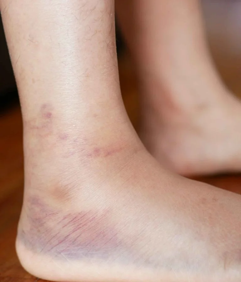 Neuropathy Signs and Symptoms