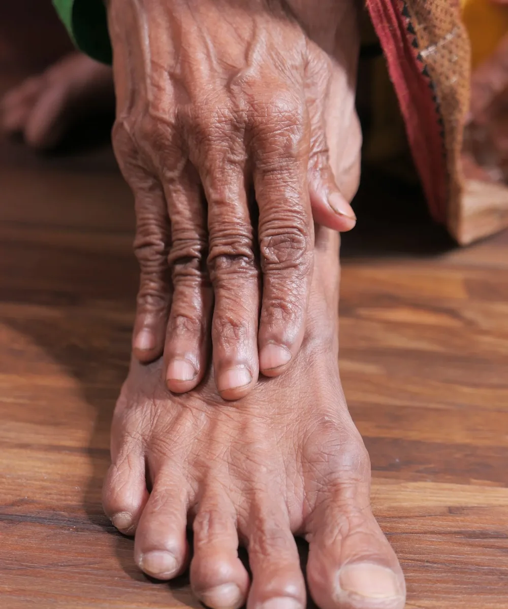 Rheumatoid Arthritis